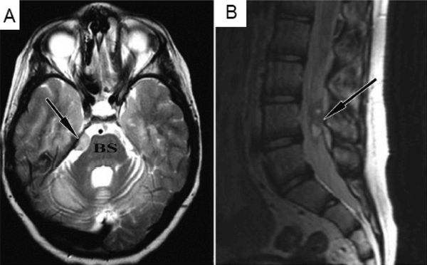 brain MRI